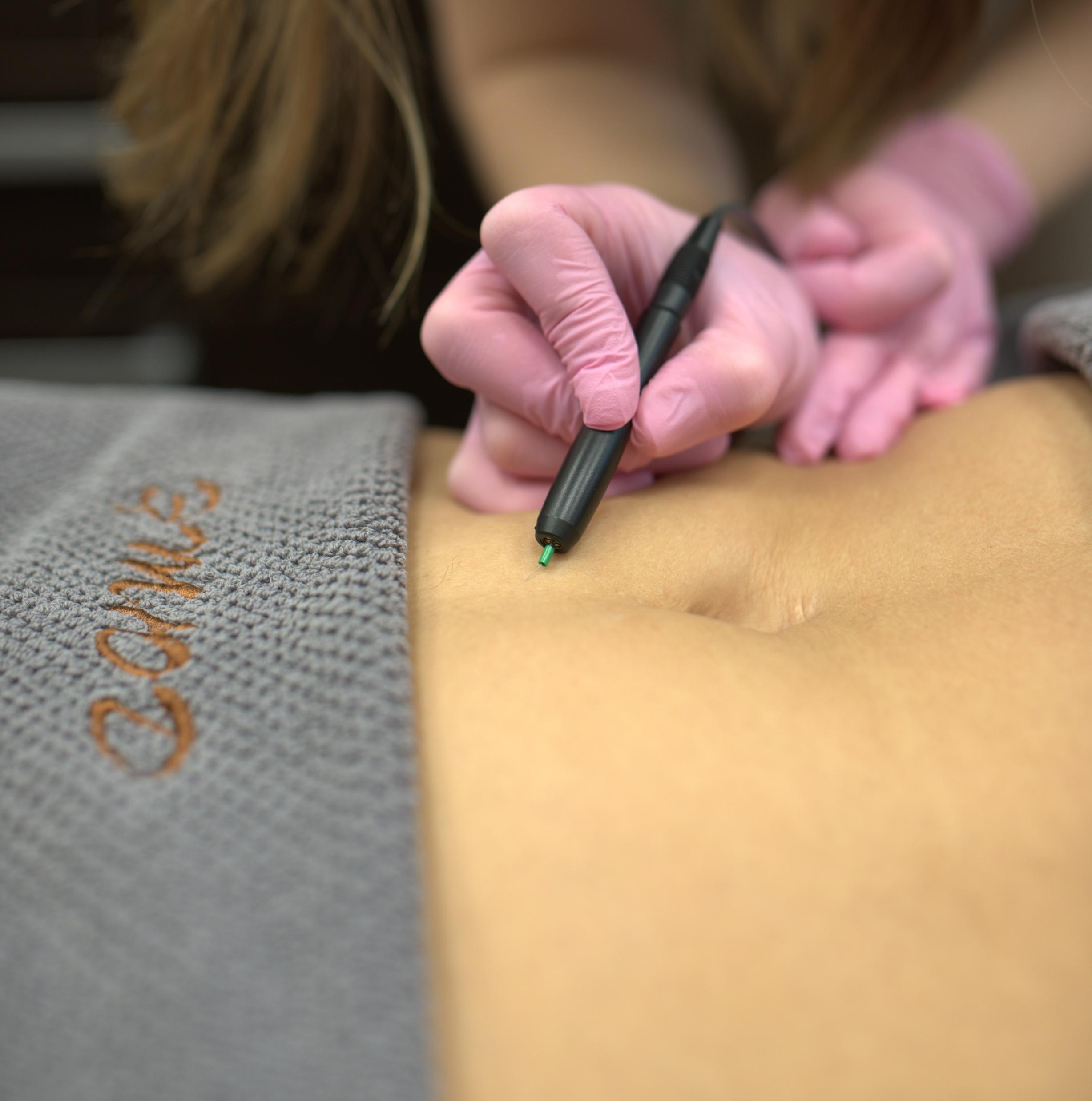 Электроэпиляция