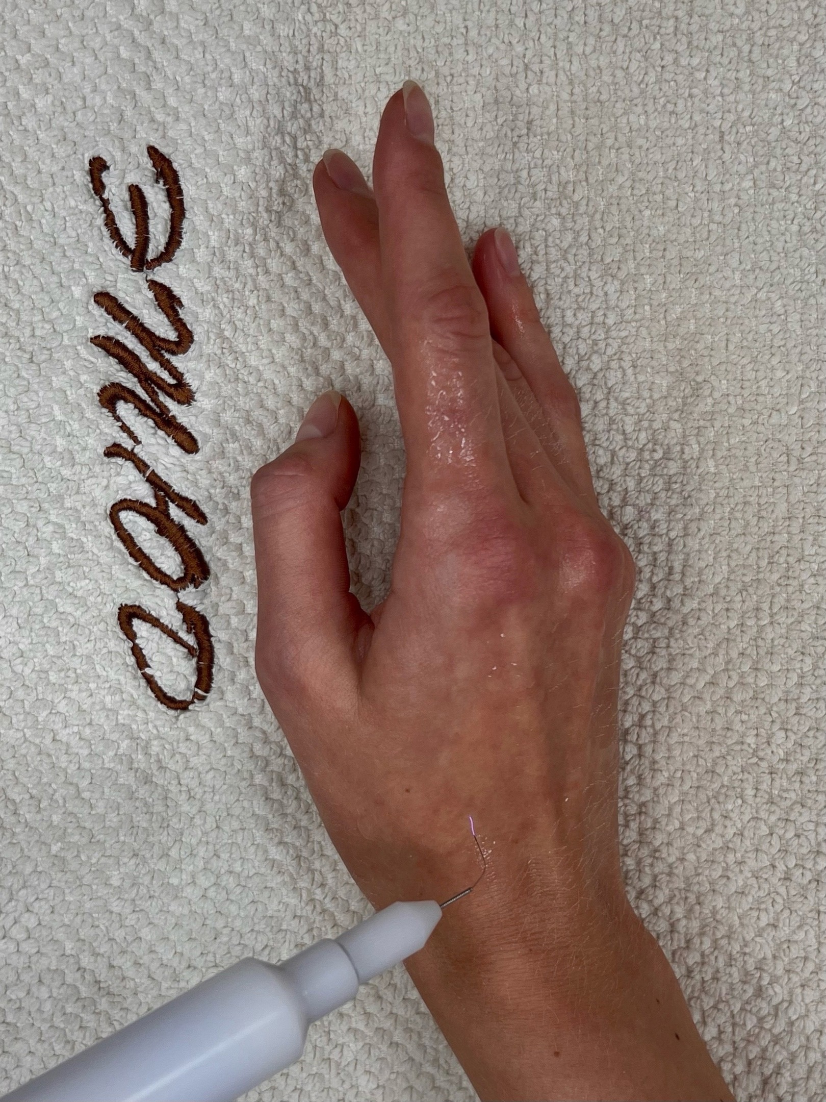 Восстановление кожного покрова кистей рук с помощью аппарата холодной плазмы